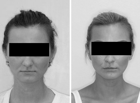 Chirurgická úprava profilu obličeje